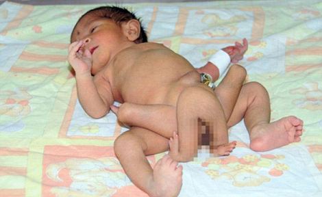 Bayi Kembar Parasit Bandung, Kasus Langka Dunia  