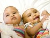 British Doctors Separate Twins Joined At Head