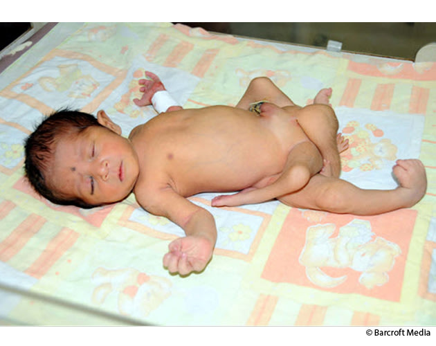 (خاص )سبحان الله معركة البقاء على قيد الحياة الرضيع ولد مع ستة أرجل في باكستان 2012 Sixlegs-jpg_121226
