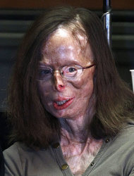 Patricia Lefranc quedó desfigurada en el 2009 por severas quemaduras en el rostro tras sufrir un ataque de su novio con ácido sulfúrico.