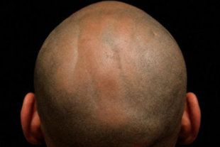 男性如在40歲前就禿頭，要小心罹患攝護腺癌的機率可能也會提高。（圖片／取材自英國《每日郵報》）