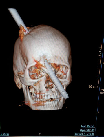This tomography scan released Thursday, Aug. 16, 2012 by the Miguel Couto hospital, show the skull of 24-year-old construction worker Eduardo Leite pierced by a metal bar in Rio de Janeiro, Brazil. Doctors say Leite survived after a 6-foot metal bar fell from above him and pierced his head. Luiz Essinger of Rio de Janeiro's Miguel Couto Hospital Friday told the Globo TV network that doctor's successfully withdrew the iron bar during a five-hour-long surgery. (AP Photo/Miguel Couto Hospital)