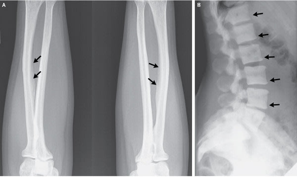 A 47-year-old U.S. woman developed a bone disease rarely seen in the U.S. after consuming an excessive amount of tea. An x-ray showed calcifications on ligaments (left) and areas of dense bone on the spinal vertebrae (right).