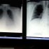 Survival rates for lung cancer diagnosis are dependent on where you live, a report suggests