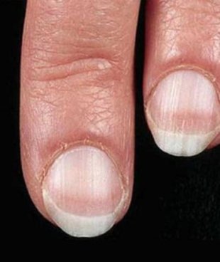 Pale nails