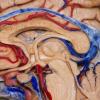 3D Brain Maps Guide Doctors — via iPhone