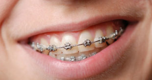 أسباب زراعة الأسنان وكيفيتها S120122312415