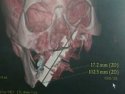 Knife removed from man's head after 4 years