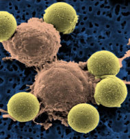 This microscopy image provided by Dr. Carl June on Wednesday, Aug. 10, 2011 shows immune system T-cells, center, binding to beads which cause the cells to divide. The beads, depicted in yellow, are later removed, leaving pure T-cells which are then ready for infusion to the cancer patients. Scientists are reporting the first clear success with gene therapy to treat leukemia, using the patients' own blood cells to hunt down and wipe out their cancer. They've only done it in three patients so far, but the results were striking: two appear cancer-free up to a year after treatment, and the third had a partial response. Scientists are already preparing to try the approach in other kinds of cancer. (AP Photo/Dr. Carl June)