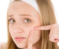 El acné afecta al 80 por ciento de la población