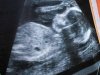'Win A Baby': Monthly IVF Lottery To Launch