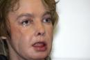 Isabelle Dinoire received the world's first face transplant in 2005