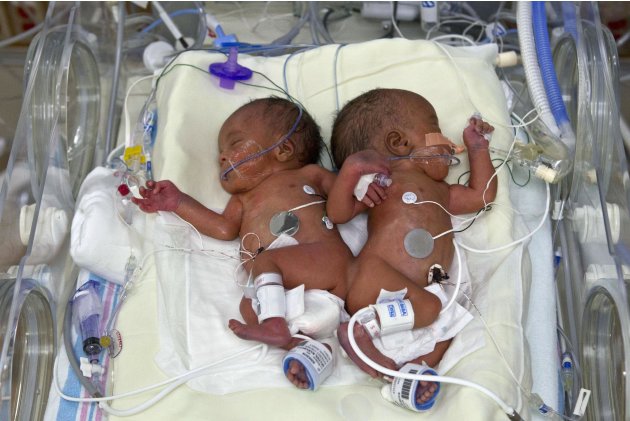 In this Jan. 25, 2011 photo provided by Le Bonheur Children's Hospital, conjoined twins Joshua, left, and Jacob Spates are shown in Memphis, Tenn. The boys were joined back-to-back at the pelvis and l