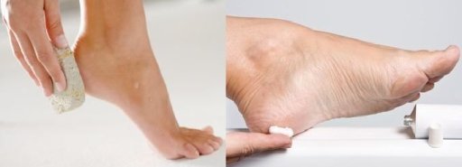نصائح ضرورية للتخلص من جفاف بشرة القدمين  20121114110101