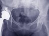 Fears Over Hip Replacement 'Poisoning'