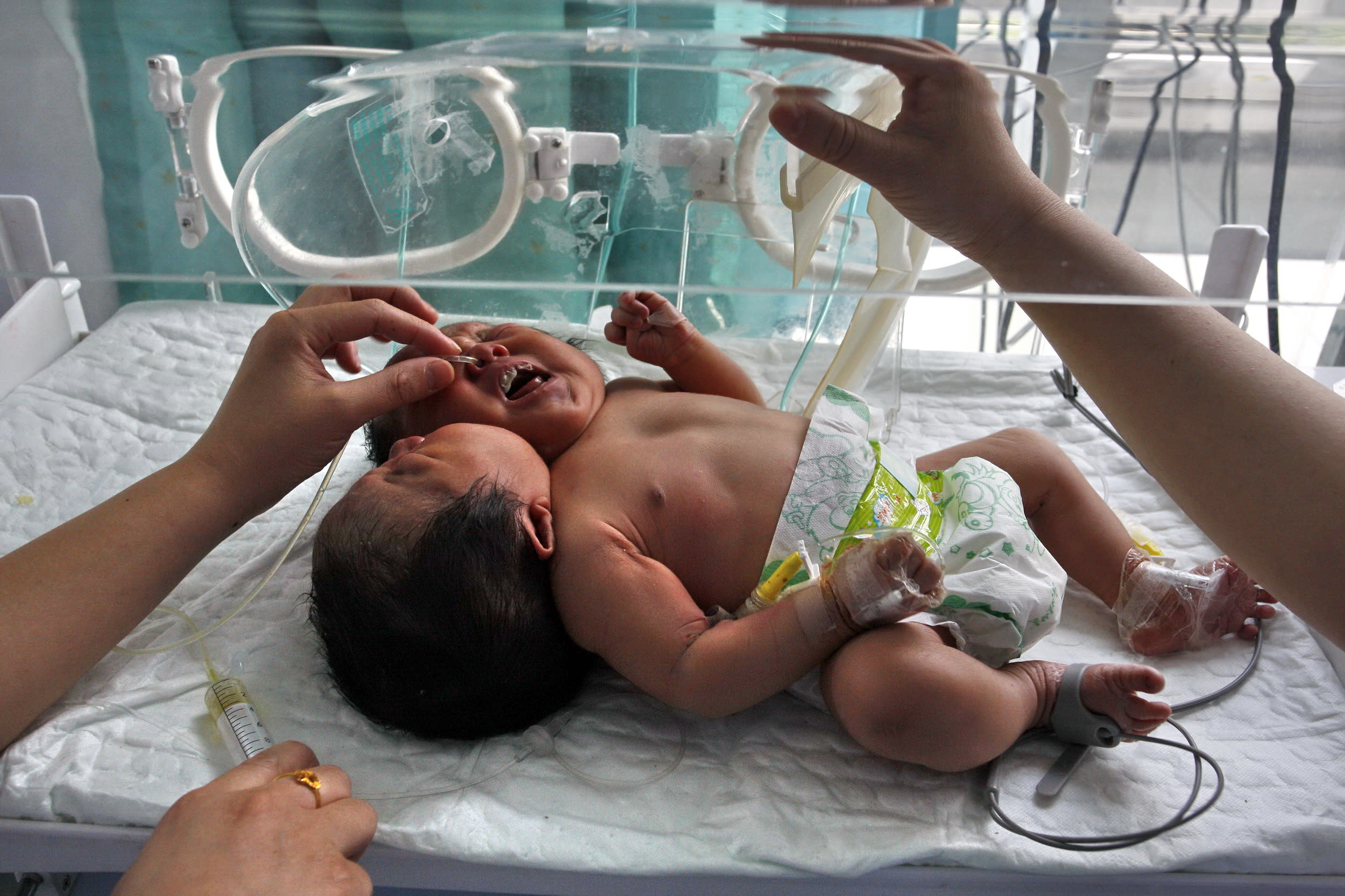 In this photo taken Monday, May 9, 2011, medical workers attend to conjoined twin babies with a single body and two heads born on May 5 in a hospital in Suining city in southwestern China's Sichuan province. The local Huaxi Metropolis Daily says the twins weighed nine pounds (4 kg) and measured 20 inches (51 centimeters) and have two spines, two esophaguses and shared other organs. Doctors were quoted as saying it would be nearly impossible to separate them.(AP Photo) CHINA OUT
