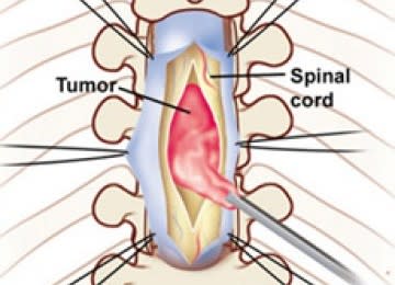 tumor di tulang belakang