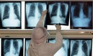 Lung Cancer: Biggest Cancer Killer Among Women