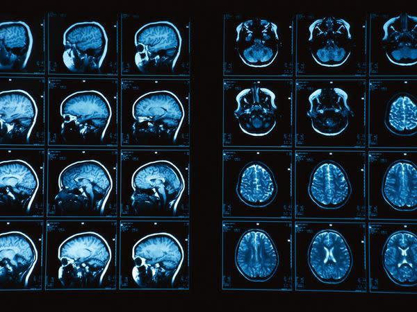 Brain MRI Scan