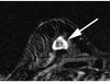 FILE - This undated file image provided in 2007 by the Duke University Department of Medicine shows a right breast MRI from a 55-year-old woman with extreme breast density. The superimposed arrow points to a 2 cm rapidly enhancing lesion which was later confirmed by biopsy to be invasive breast cancer. Doctors have successfully dropped the first "smart bomb" on breast cancer, using a drug to deliver a toxic payload to tumor cells while leaving healthy ones alone, doctors plan to report Sunday, June 3, 2012. (AP Photo/Duke University Department of Medicine, File)
