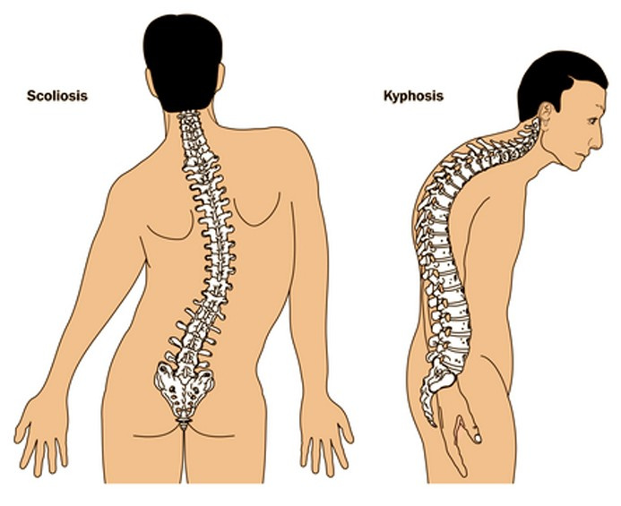 Pictures collection of the medical condition Kyphosis…