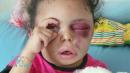 An injured Yemeni child's image went viral. Then she disappeared to Saudi Arabia.