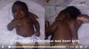 Infant's Rare 'Parasitic Twin' Successfully Removed with Surgery