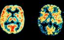 Brain scanning could improve dementia diagnosis for two thirds of patients, study finds