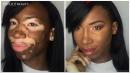 Watch Amazing Makeup Transformation of Model With Vitiligo