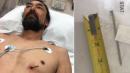 Man Whose Heart Was Pierced by 3-Inch Nail Drives Himself 12 Miles to Hospital