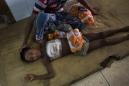 Bangladesh hospital struggles to cope with Rohingya wounds